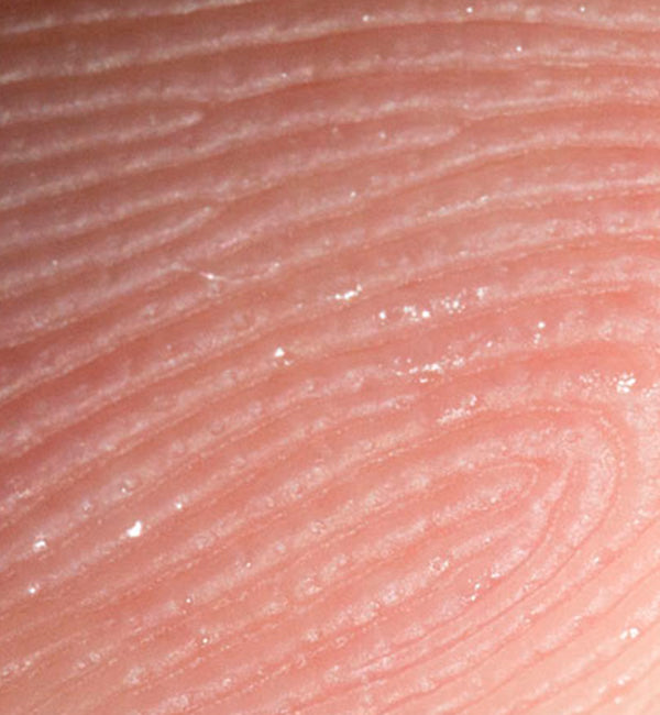 A closeup image of shards of fiberglass in a persons skin ouch